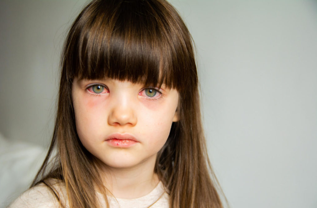 A close-up of a little child with pink eye.
