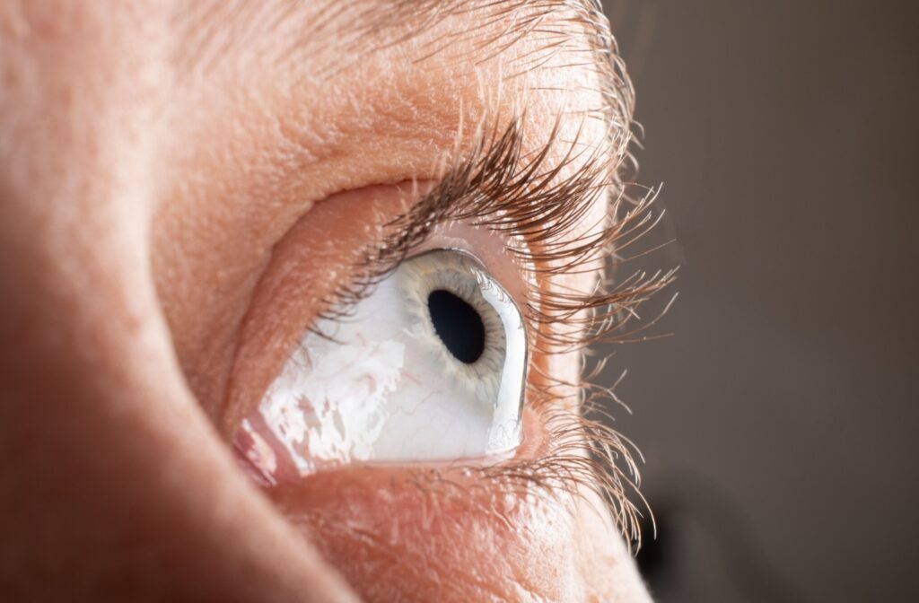 A closeup of someone's eye, their cornea curved from the progression of keratoconus