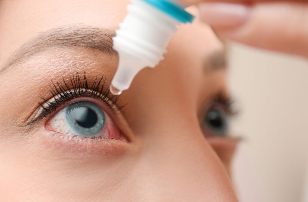 A close-up of an eye with visible redness as a person applies eye drops from a small bottle.